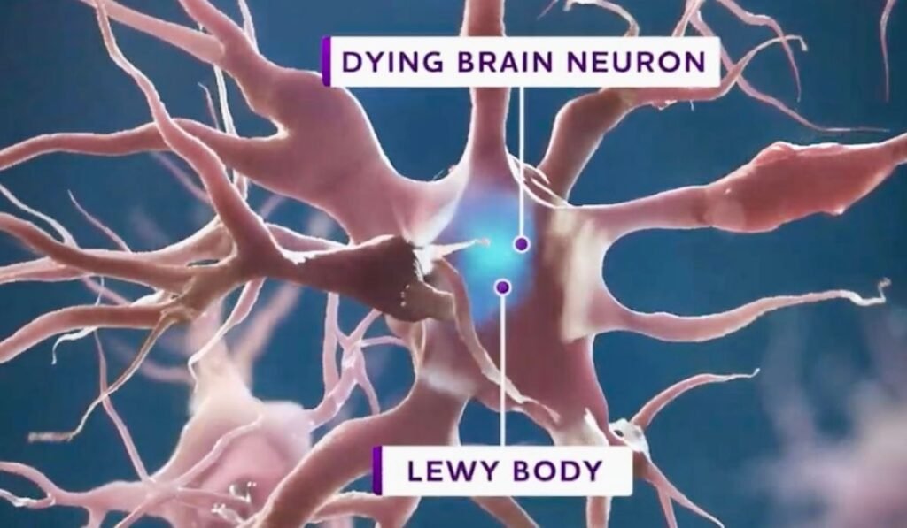 lewy body dementia