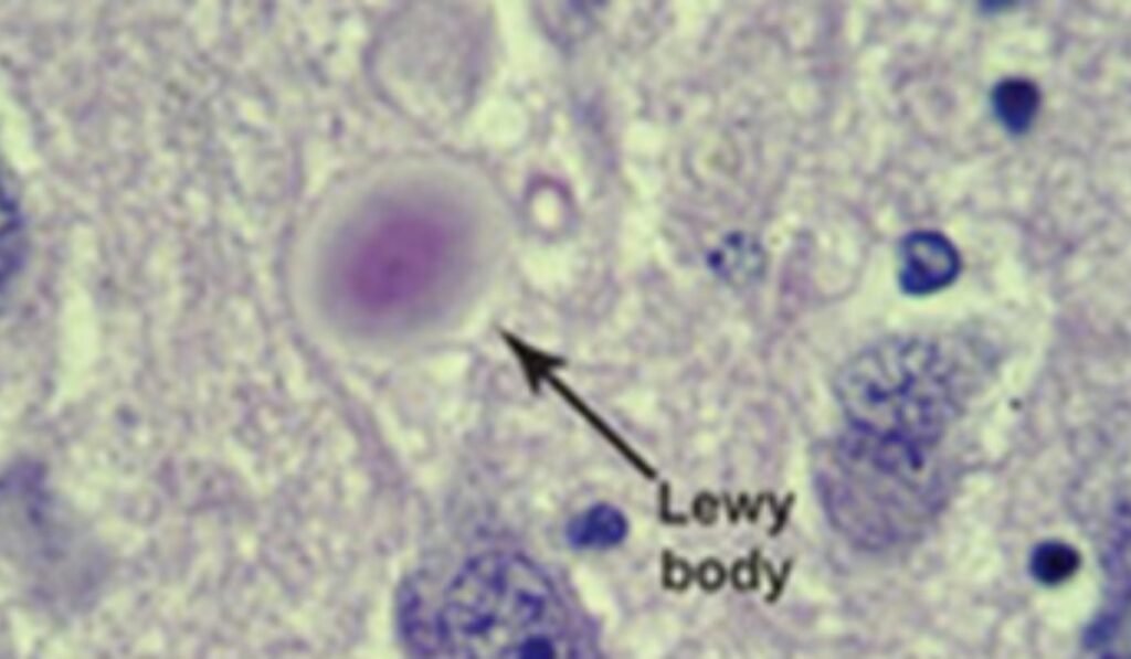 lewy body dementia