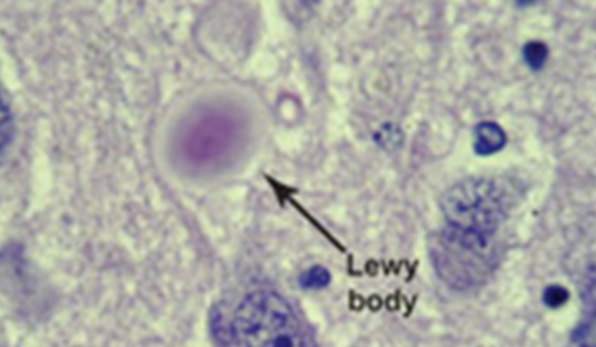 Lewy Body Dementia Symptoms, Causes, Diagnosis, Treatment Options, and ...