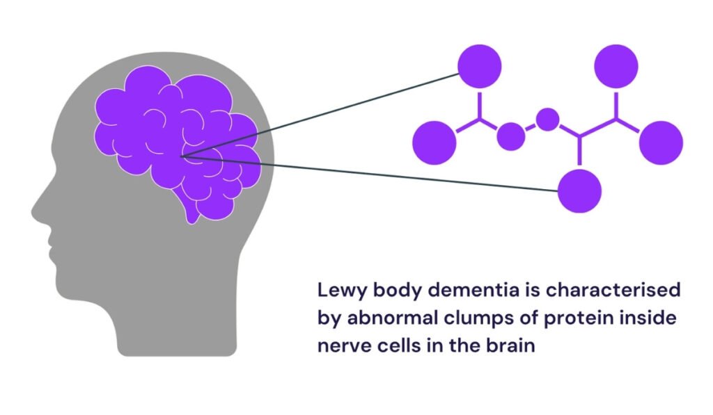 lewy body dementia