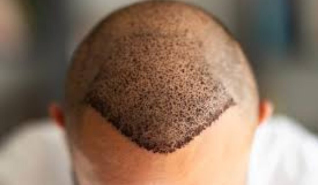 The Definitive Guide to Hair Transplant Turkey: Transforming Your Appearance with Global Expertise hair transplant turkey