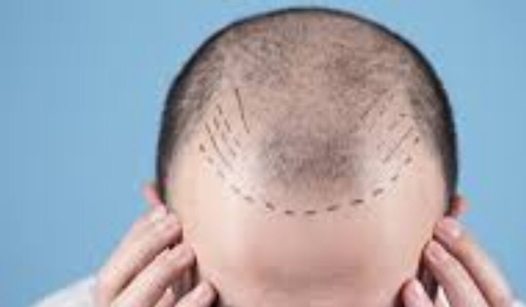 hair transplant turkey